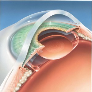 chirurgie-cataracte-implant-multifocal-acrysof